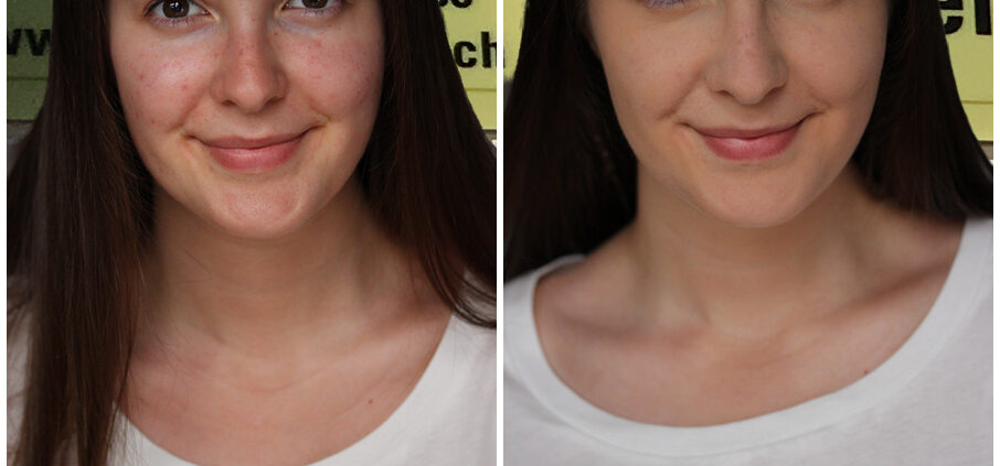 Mit Microneedling gegen Akne