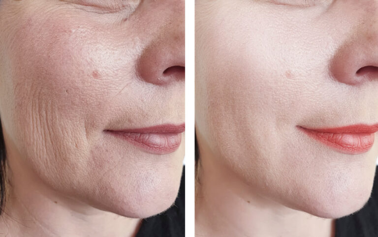 Porentief rein - Mesoporation mit Hydrofacial
