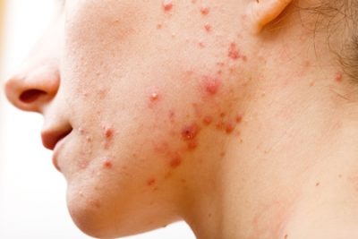 Akne-Behandlung bei Kosmetik Lee