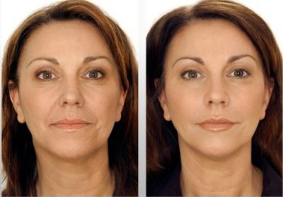 Microneedling Kosmetik Lee