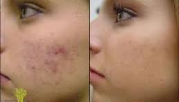 Resultate einer Microdermabrasion