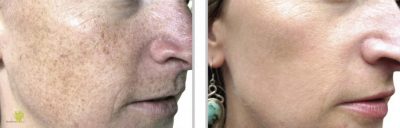 Verbesserung des Hautbildes dank Microdermabrasion