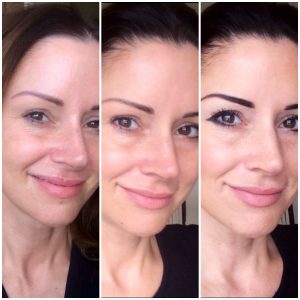 Vor, während und nach einem Microneedling