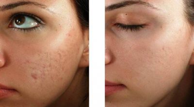 Mesotheraie - Microneedling