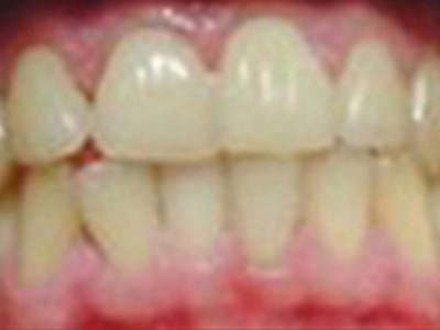400-300-lee-zahnaufhellung-durch-kosmetik-studio-basel zahnaufhellung durch kosmetik studio basel
