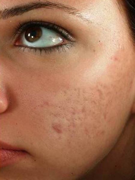 450-600-LEE-micro-needling1-Kosmetik-Studio-Basel micro needling1 Kosmetik Studio Basel