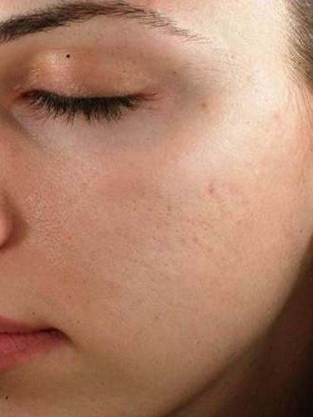 450-600-LEE-micro-needling2-Kosmetik-Studio-Basel Radiofrequenz Microneedling