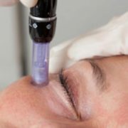 micro needling face treatment kosmetik studio basel