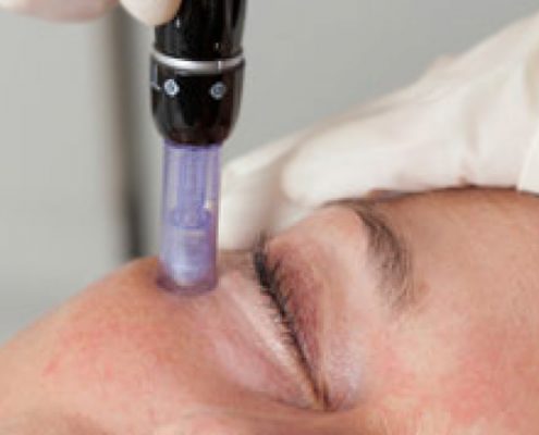 micro needling face treatment kosmetik studio basel