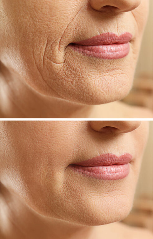 Mesoporation Gesichtsbehandlung Anti-Aging