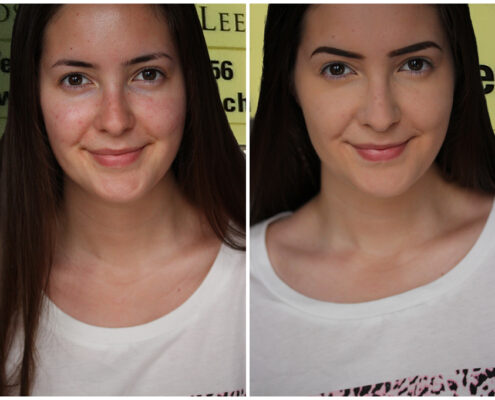 Mit Microneedling gegen Akne