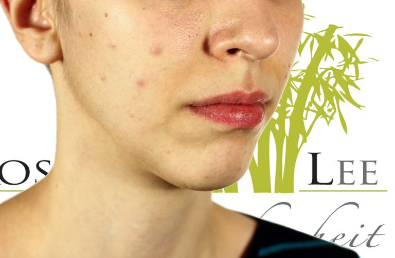 Kosmetik Lee - gegen Akne und unreine Haut