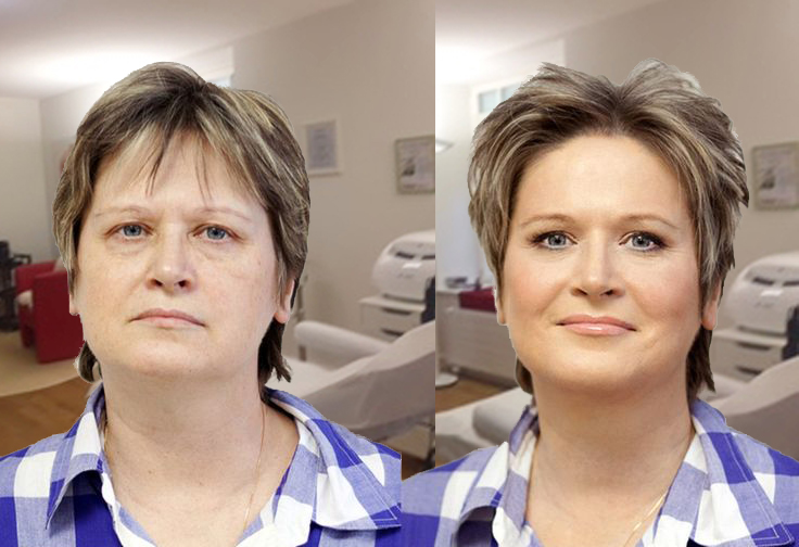 Aqua-Peeling vorher nachher