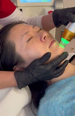 RF Microneedling durch Kosmetik Lee in riehen