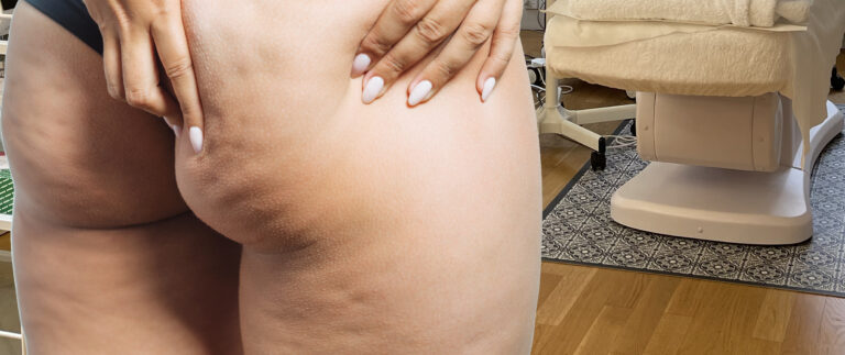 Radiofrequenz gegen Cellulite