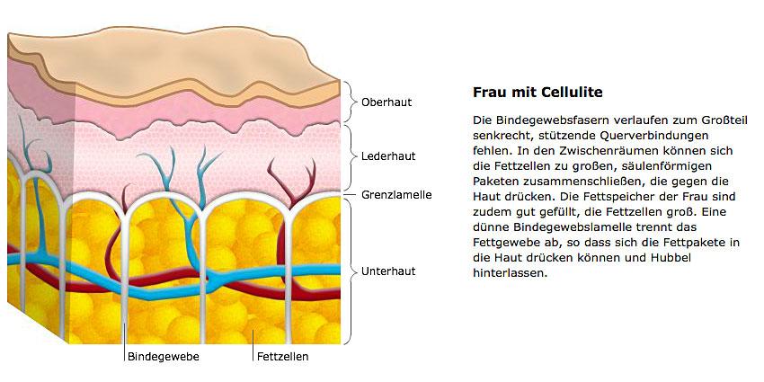 3D HIFU gegen Cellulite