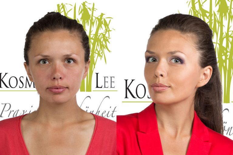 Vor und Nach RF Microneedling by Kosmetik Lee