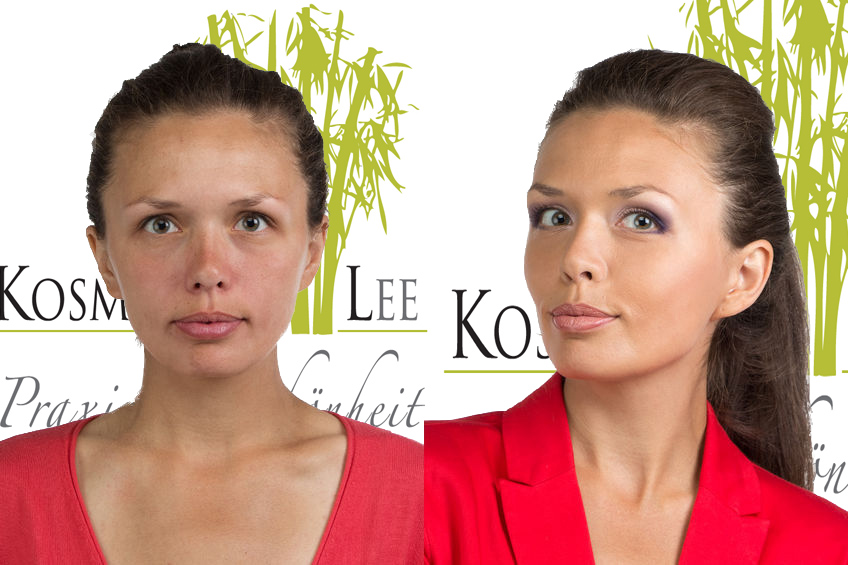Vor und Nach RF Microneedling by Kosmetik Lee