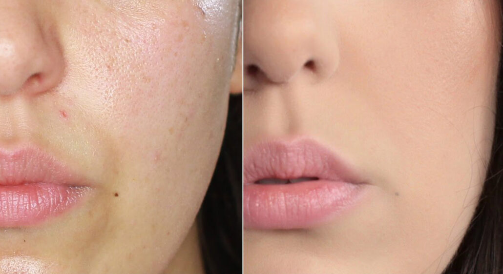 HydroFacial gegen grosse Poren
