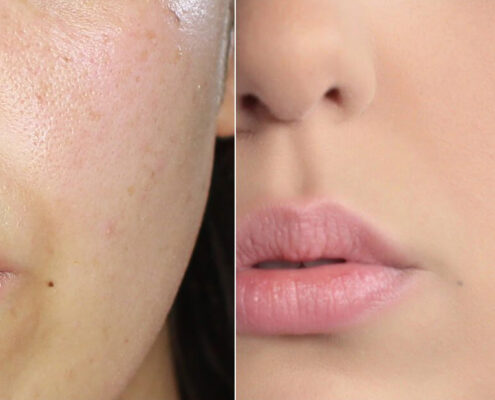 HydroFacial gegen grosse Poren