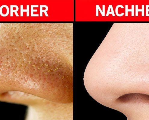 Grosse Hautporen behandeln