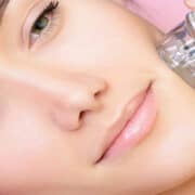 Kosmetik Lee's RF Microneedling
