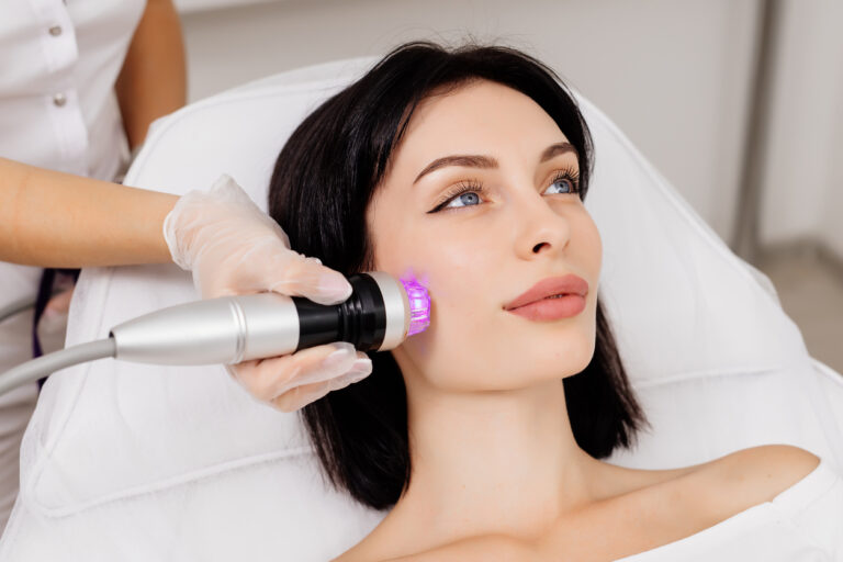 RF Microneedling gegen Aknenarben ud Falten