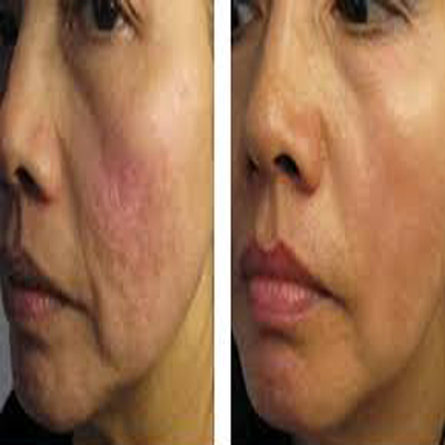 Micro-Needling