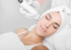 Aknenarben, Akne Narben RF Microneedling