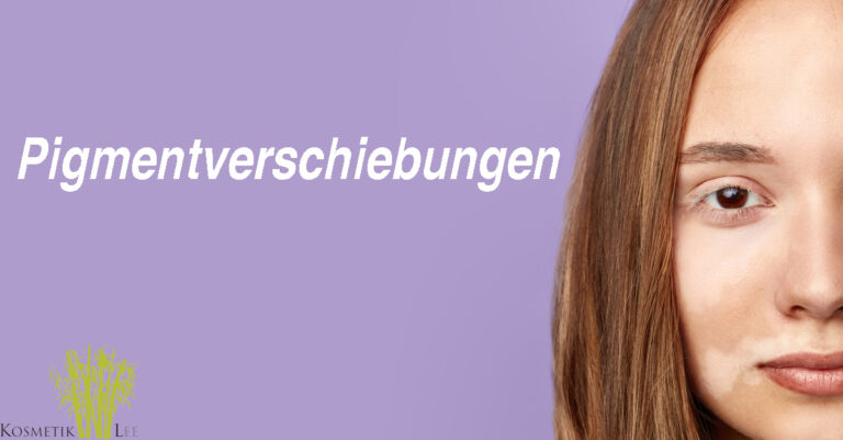 Pigmentflecken, Pigmentverschiebung