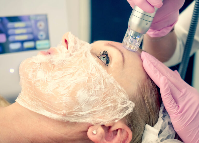 RF-Microneedling - TDA Kombibehandlung