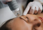 Microneedling mit TDA
