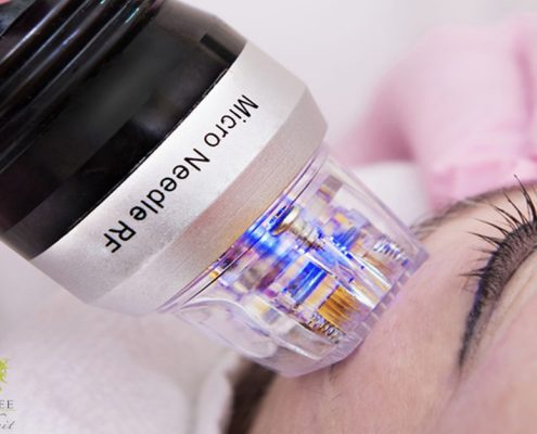 RF_Microneedling Skin brightening Radiofrequenz Microneedling