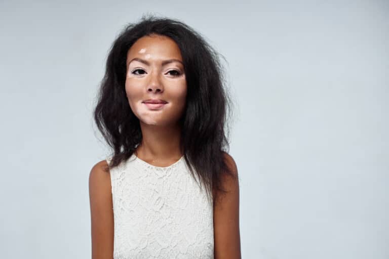 Pigmentflecken reduzieren Vitiligo