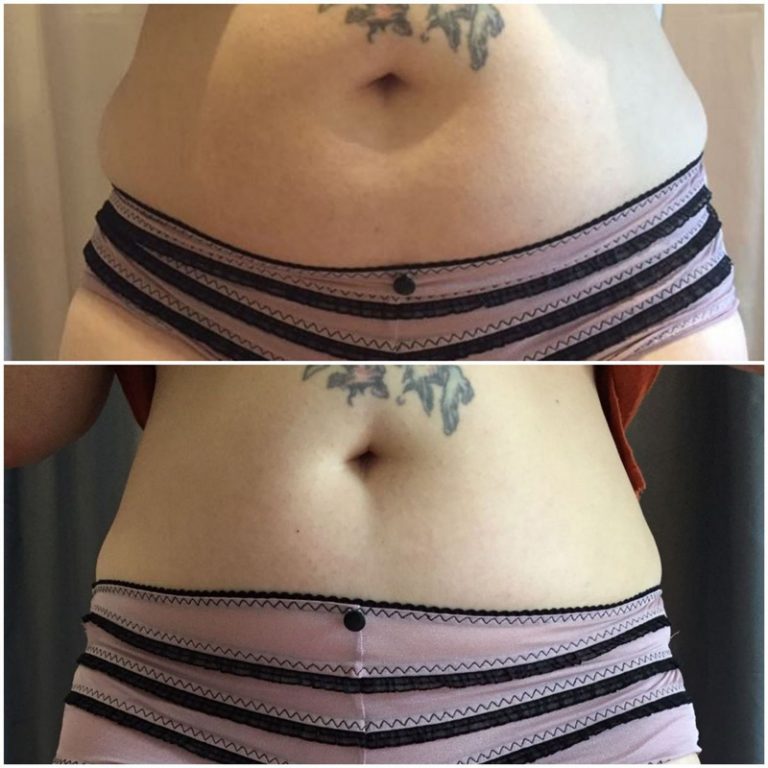 Cellulite Bauch Straffung