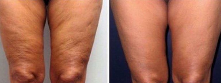 Cellulite Oberschenkel