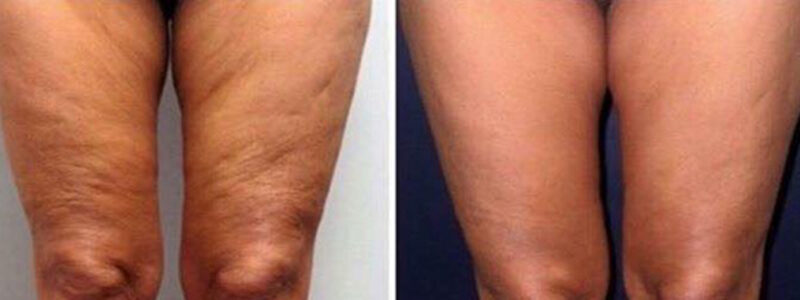 Cellulite Oberschenkel
