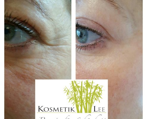 Hautstraffung RF Microneedling TDAHautstraffung